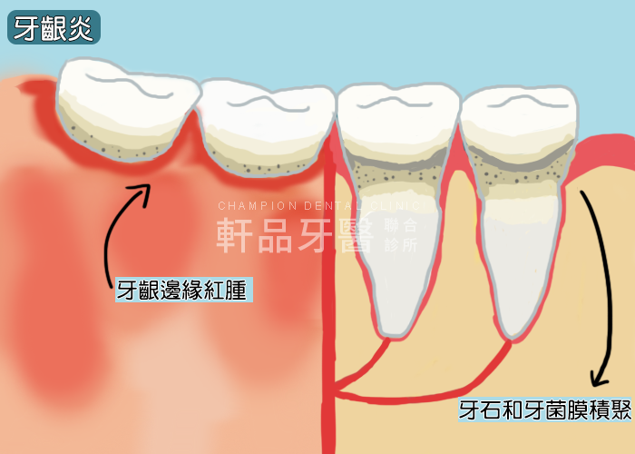 什麼是牙周病1-1