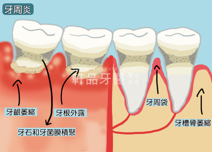 什麼是牙周病1-2